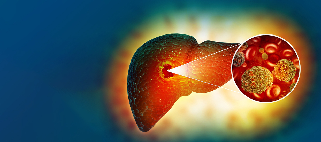 Liver Cancer: Symptoms, Diagnosis & Treatment Options